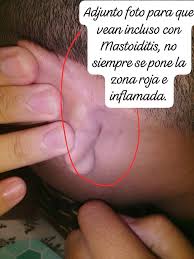 Image result for Mastoiditis