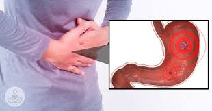 Pin On Stomach Ulcers Symptoms