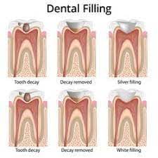 On average, the cost of a filling with insurance can be around $132 for an amalgam filling, which is often the cheapest filling option, with most on average, a tooth filling can cost anywhere from $150 to $530 without insurance. Dental Filling Tooth Filling Cavity Filling Dentalsave Dental Plan