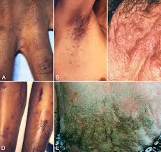 Image result for scabies in the groin area