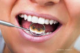 Häufig werden die fehlstellungen mittels einer zahnspange reguliert. Unsichtbare Zahnspangen Invisalign Vs Incognito Kosten Vor Nachteile