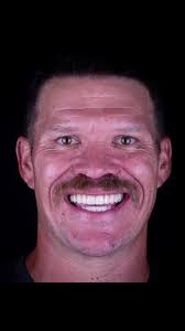 Micah Wallace Teeth Before and After