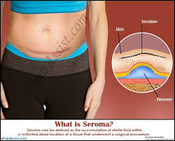 When Can You Have A Tummy Tuck After C Section What Is Seroma Treatment Tummy Tucks Hernia Repair