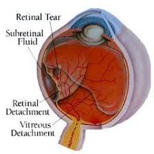 The majority of retinal breaks, holes, or tears are spontaneous, result when the vitreous gel pulls loose or separates from its attachment to the retina, usually in the peripheral parts of the retina. Retinal Detachments Tears Cape Fear Retina Wilmington