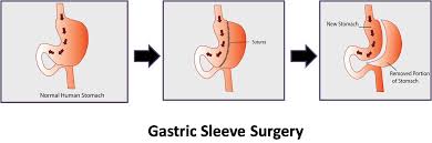 weight gain after gastric sleeve surgery