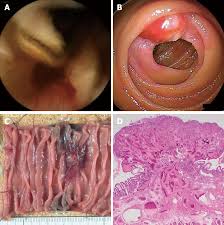 Image result for Small Intestinal Bleeding