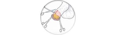 Circuncision En Varones De Edad Avanzada Dr J Romero