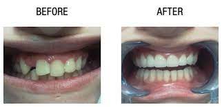 These average dental bridge costs do not account for the wings or crowns, which can each cost $250 to $500 or more depending on the type. Dental Bridge Uk Procedures And Cost Novacorpus