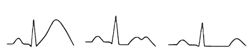 Long Qt Syndrom Lqts Medizinisch Genetisches Zentrum