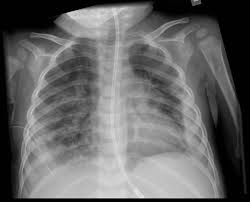 Image result for Chest XRay Interpretation