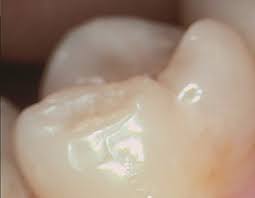 Ursachen Fur Langsfrakturen Endodontie Dr Eggert