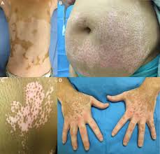 Revised classification/nomenclature of vitiligo and related issues: Vitiligo Mechanistic Insights Lead To Novel Treatments Journal Of Allergy And Clinical Immunology