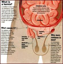 Hernia incisional boleh berlaku selepas anda menjalani pembedahan abdomen. Awas Gejala Angin Pasang Panduan Kesihatan