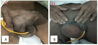 Image result for Inguinal hernia man