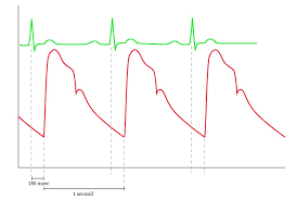 Normal Arterial Line Waveforms Deranged Physiology