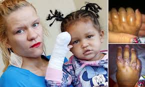 Toddler could be scarred for life after putting hand