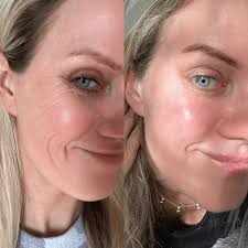 0.5mm Dermaroller (Real Individual Needles®)