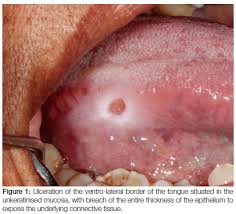 Image result for mouth ulcer on tongue)