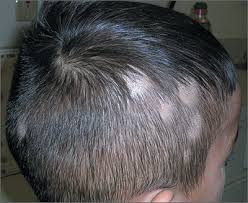 But it's important to note that the headaches are not caused by the hair falling out. Hair Loss On Scalp Mdedge Family Medicine