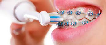 Some older kids may still. How To Brush Your Teeth When Wearing Braces Smile Pad