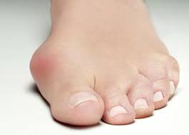 Der hallux valgus, auch „großzehenballen genannt, ist in der fußchirurgischen praxis das häufigste krankheitsbild. Die Behandlung Op Des Hallux Valgus Ballenzeh Oder Grosszehenballen