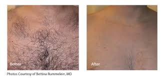 I was disturbed by my experience and last session. Laser Hair Removal Irvine Laser Hair Removal In Orange County