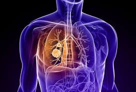 Breast cancer that has spread to the bones may cause: Lung Cancer Signs Symptoms Stages Treatment Survival Rate