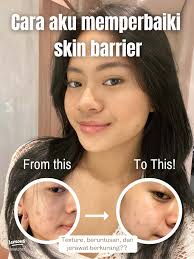 Perbaiki Skin Barrier dan Atasi Jerawat dengan Mudah