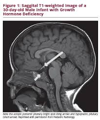 Congenital Growth Hormone Deficiency A Review With A Focus On Neuroimaging Touchendocrinology