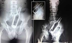 X-rays show bottle stuck in man's rear... and a hooked wire | Daily Mail  Online