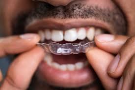 Why do invisalign providers charge different prices? Invisalign Can Help Straighten Your Teeth But Requires Good Maintenance