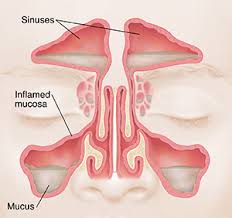Image result for Rhinosinusitis