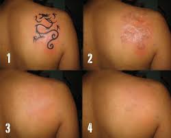However, the portland trailblazers guard may have the ink removed if the raiders cut brown. Kelly Osbourne Getting Tattoos Removed Celebrity Diagnosis
