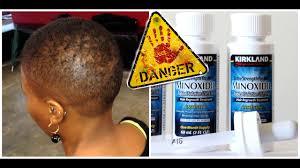Men's rogaine 5% minoxidil foam for hair loss and hair regrowth, topical treatment for thinning hair. Danger Of Minoxidil Rogaine Treatment Hair Growth Josiphia Rizado Youtube