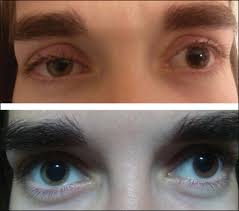 Image result for Pupillary Paralysis