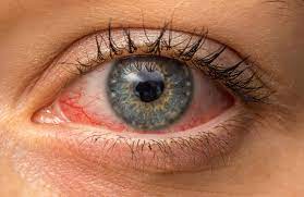 Die virale konjunktivitis gilt als eine der häufigsten augenerkrankungen. Bindehautentzundung Was Tun Bei Konjunktivitis Iclinic