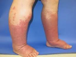 Image result for Lipodermatosclerosis