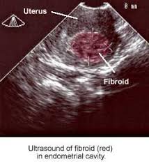 Complications arise when cysts become abnormally large. Diagnosis Of Fibroids