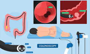 It's important to have regular screening tests, such as a colonoscopy, because colon polyps found in the early stages can usually be removed safely and completely. Colonoscopy Screening For Colorectal Cancer How To Prepare Health Plus
