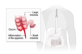 Appendicitis is inflammation of the appendix. Appendicitis Causes Symptoms Early Signs Recovery And Treatment