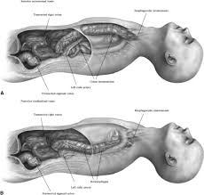 Eleven patients with benign postoperative colonic strictures were treated with balloon dilatation november, 1990, through november, 1995. Colon Interposition For Staged Esophageal Reconstruction Operative Techniques In Thoracic And Cardiovascular Surgery