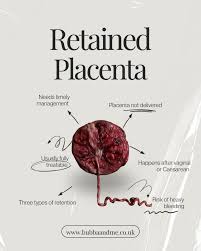 Image result for Retained Placenta