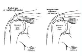 Image result for Rotator Cuff Injury
