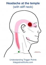 Side Of Headintegrative Works Integrative Works Home Remedy For Headache Headache Remedies Trigger Points
