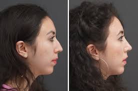 Rhinoplasty in Denver, CO