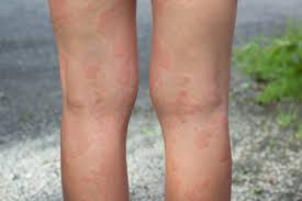 Pentru ca aceste infectii sunt, in general, virale, nu este nevoie de tratament antibiotic. Urticaria Diagnostic È™i Tratament Newsmed Ro