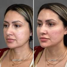 Albuquerque Full Face Balancing Before & After: Chrome Aesthetics