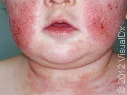 Image result for Atopic eczema atopic dermatitis