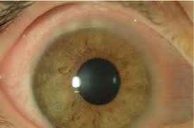 Image result for Vernal Conjunctivitis