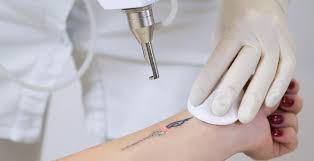 Laser Tattoo Removal | SILKOR UAE